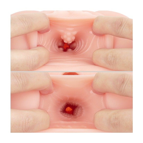 극상 질육 생음순